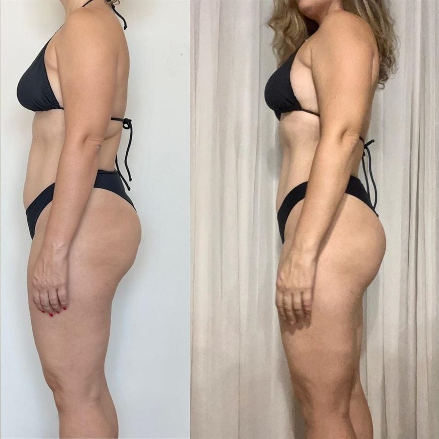 Antes e depois de uma paciente do Método SS, de perfil: à esquerda antes, à direita depois, com o abdômen mais plano