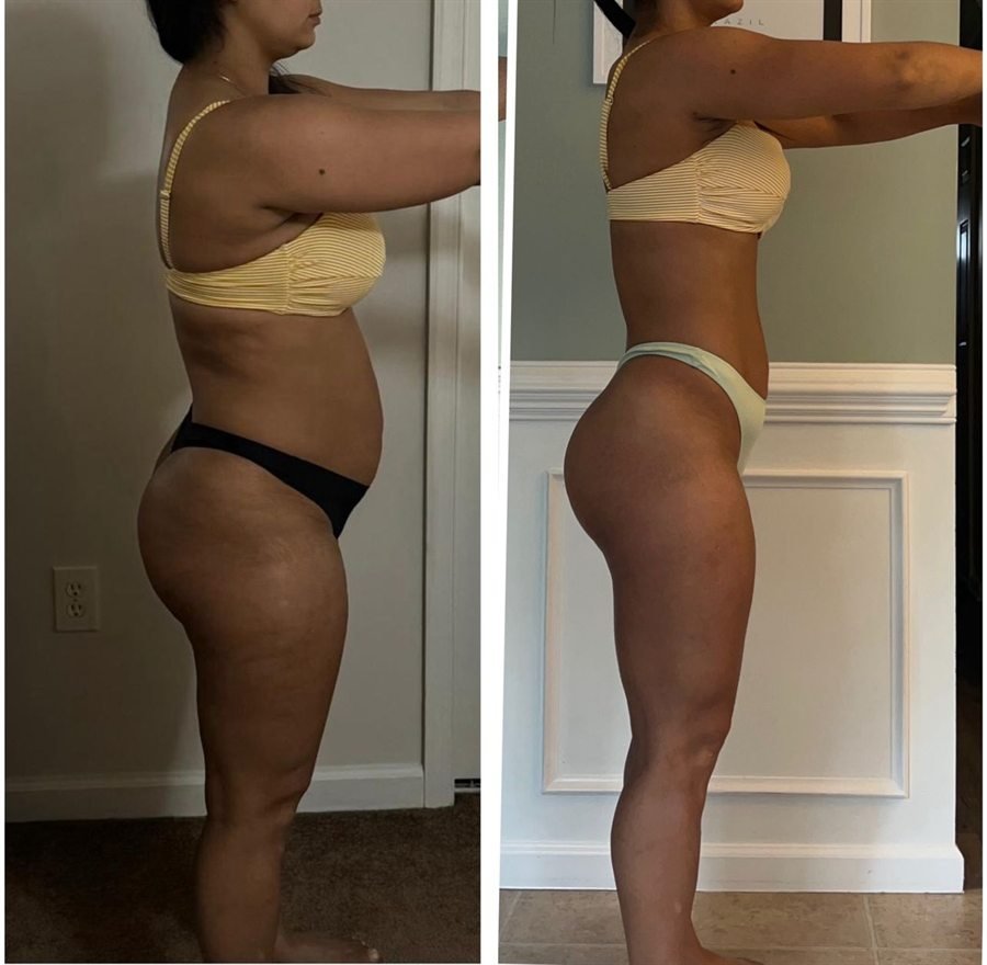 Antes e depois de outra paciente, de perfil: à esquerda antes do acompanhamento, à direita depois, com o abdômen mais plano e a cintura definida